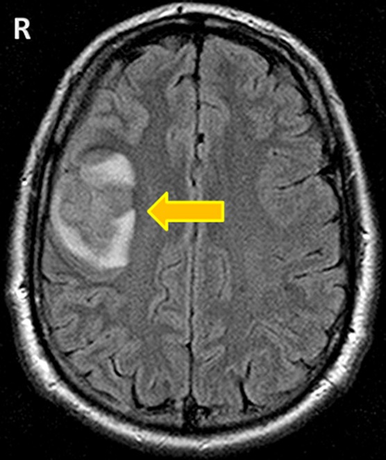 Snapshot in surgery: brain abscess as a complication of a recurrent sigmoid diverticular abscess