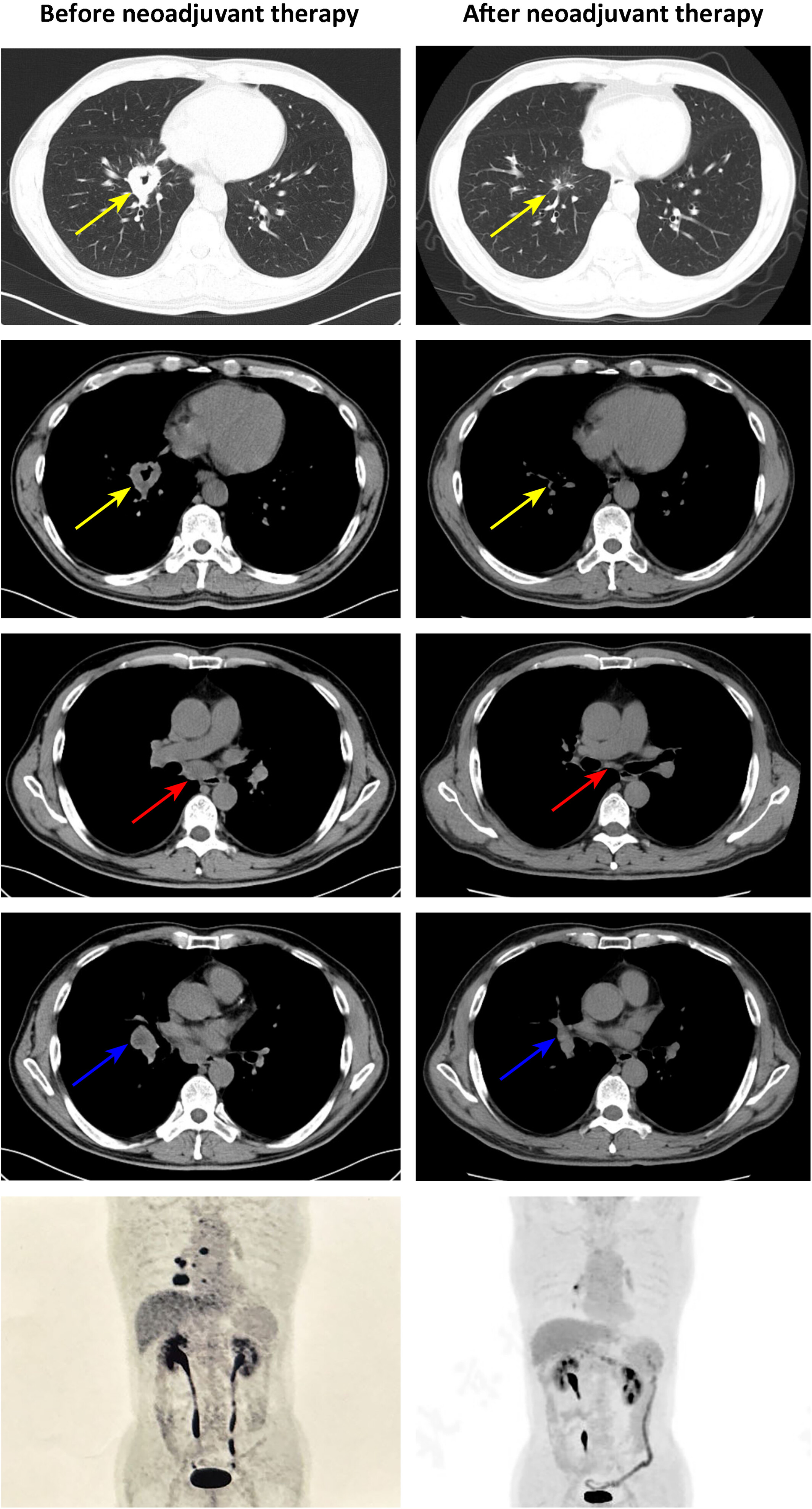 Remarkable pathological response to neoadjuvant tepotinib in lung adenocarcinoma with MET exon 14 skipping mutation: A case report