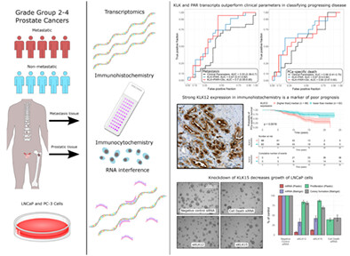 Prognostic impact of kallikrein-related peptidase transcript levels in prostate cancer