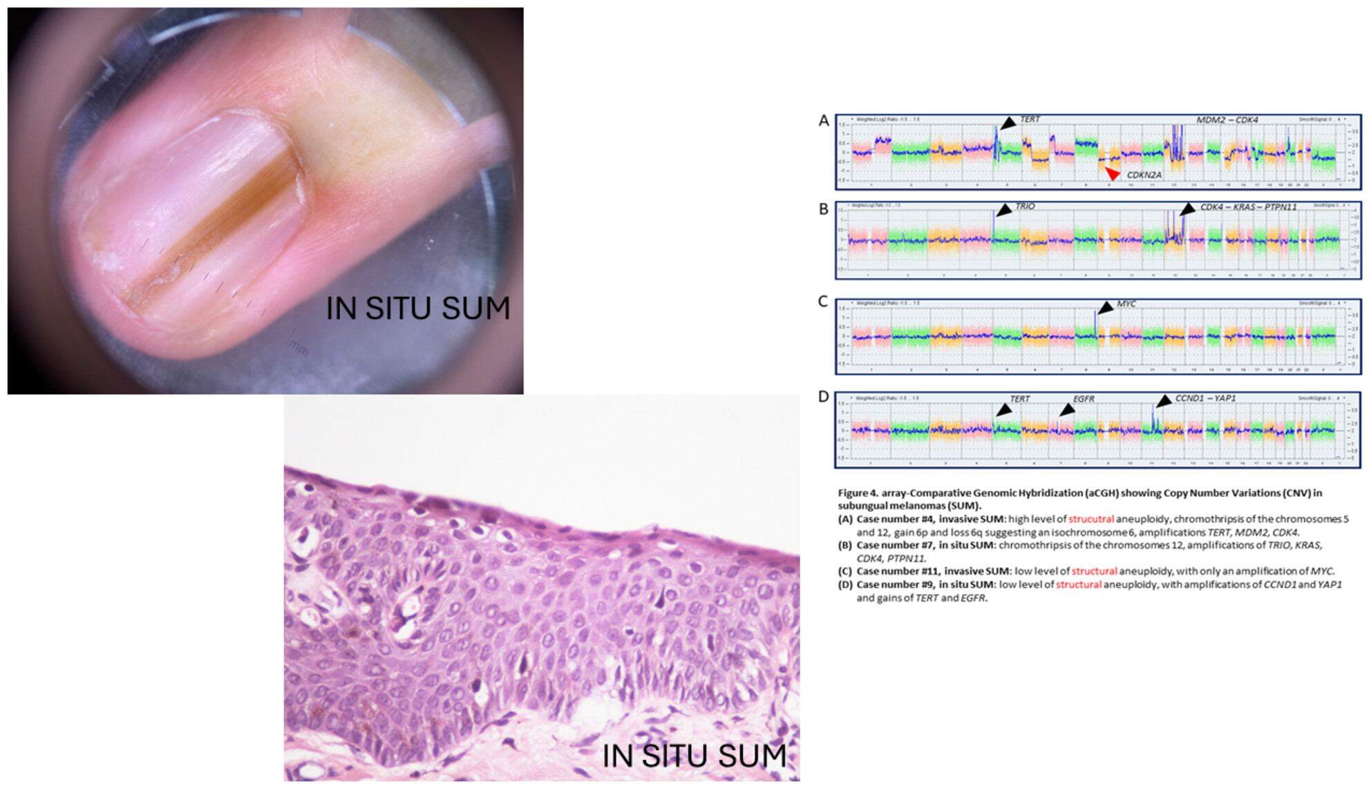 Subungual melanoma: molecular analysis of 31 cases from early stage to invasive melanoma