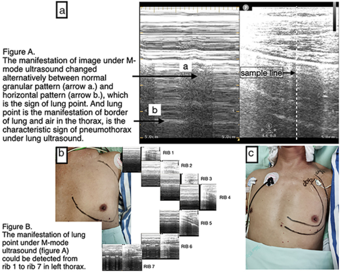 Tracheal fistula in a patient after esophageal surgery confirmed by lung ultrasound: A new bedside tool for thoracic surgeons