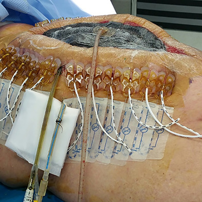 The Abdominal Re-Approximation Anchor device (ABRA®) has the potential to be useful in both emergency and elective dynamic temporary fascial closure