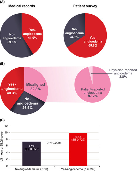 Angioedema in chronic spontaneous urticaria is underdiagnosed and has a substantial impact: Analyses from ASSURE-CSU