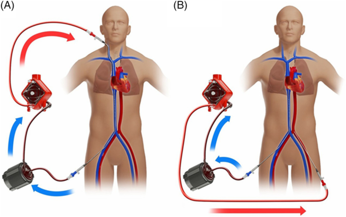 Optimization of extracorporeal membrane oxygenation therapy using near-infrared spectroscopy to assess changes in peripheral circulation: A pilot study