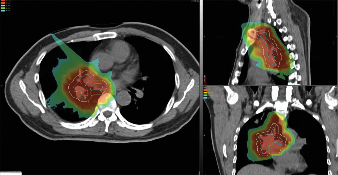 Carbon ion radiotherapy in the management of non-small cell lung cancer