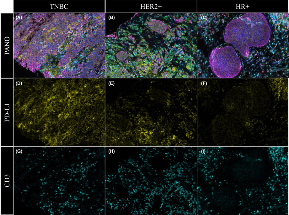 Comparison of the tumor immune microenvironment phenotypes in different breast cancers after neoadjuvant therapy