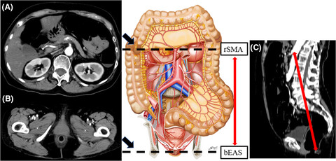 Long Distance Between the Superior Mesenteric Artery Root and Bottom of the External Anal Sphincter Is a Risk Factor for Stoma Outlet Obstruction After Total Proctocolectomy and Ileal-Pouch Anal Anastomosis for Ulcerative Colitis