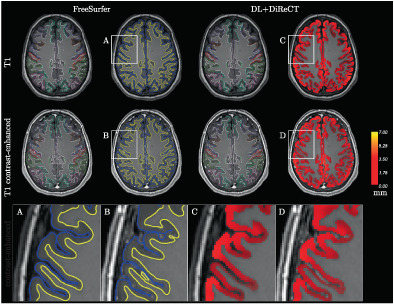 Reliable brain morphometry from contrast-enhanced T1w-MRI in patients with multiple sclerosis
