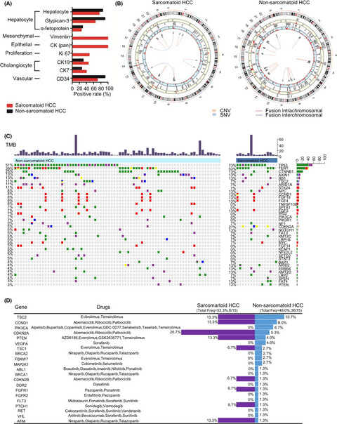 Sarcomatoid hepatocellular carcinoma: From clinical features to cancer genome