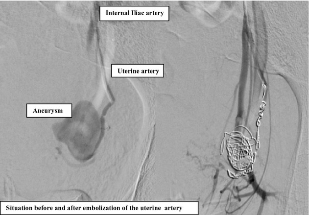 Embolization of a left uterine artery mycotic aneurysm after a neglected, perforated appendicitis before delivery