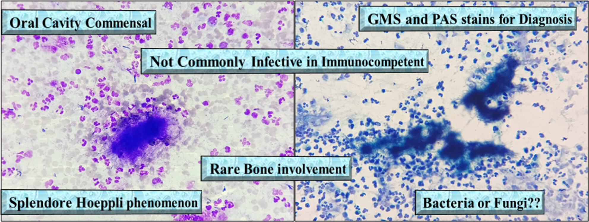 Regular resident becomes aggressive enemy: Diagnosed on cytology