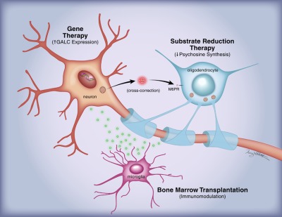 Treatment for Krabbe's disease: Finding the combination