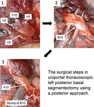 Uniportal thoracoscopic left posterior basal segmentectomy using a posterior approach