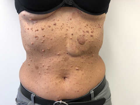 Cutaneous manifestations in Moyamoya angiopathy: A review