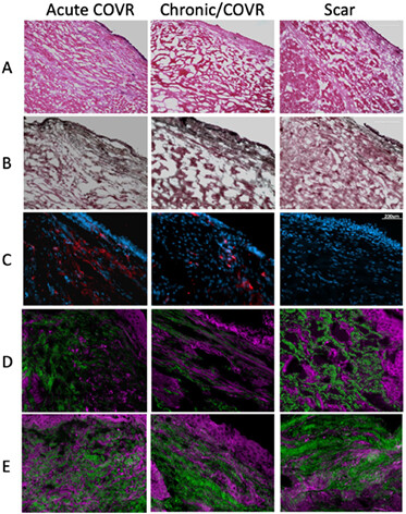 Cell-Based Outer Vocal Fold Replacement Both Treats and Prevents Vocal Fold Scarring in Rabbits