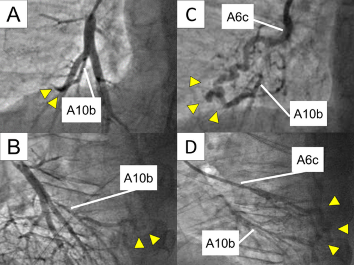 Abnormal anastomosis of peripheral pulmonary arteries, initially suspected to be an arteriovenous fistula, in an adult with Williams syndrome
