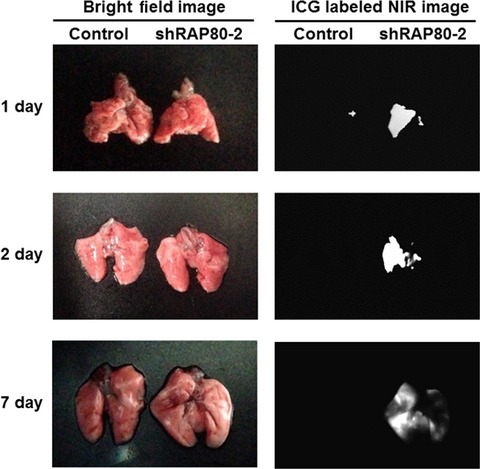 RAP80 regulates epithelial–mesenchymal transition related with metastasis and malignancy of cancer