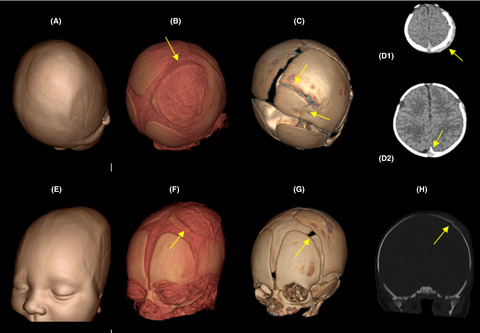 A parietal bone fracture with subgaleal and subdural hemorrhage in association with vacuum extraction delivery