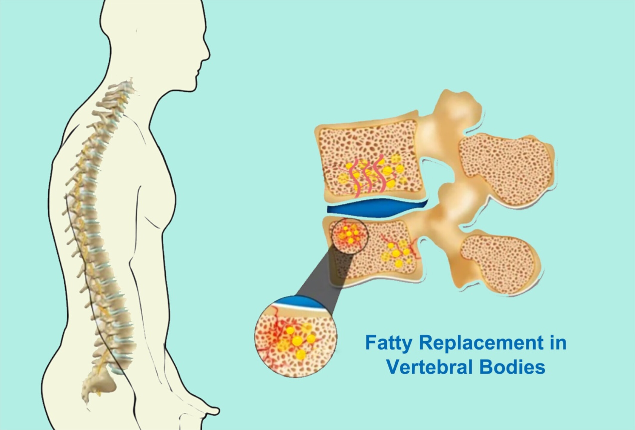 Gut Microbiome and Metabolome Changes in Chronic Low Back Pain Patients With Vertebral Bone Marrow Lesions