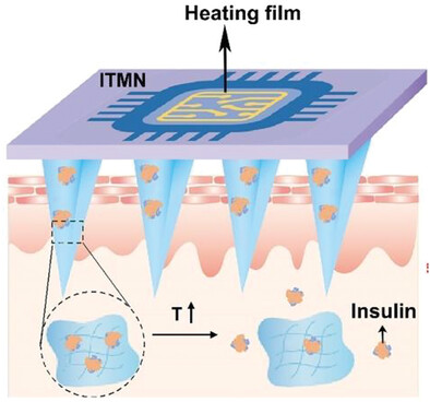 Thermosensitive Microneedles Capable of On Demand Insulin Release for Precise Diabetes Treatment