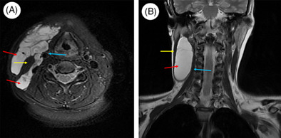 Cervical lymphangioma in adults: A report of seven cases and review of the literature