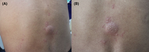 An orange peel-like nodule on the back: A case of Wells syndrome