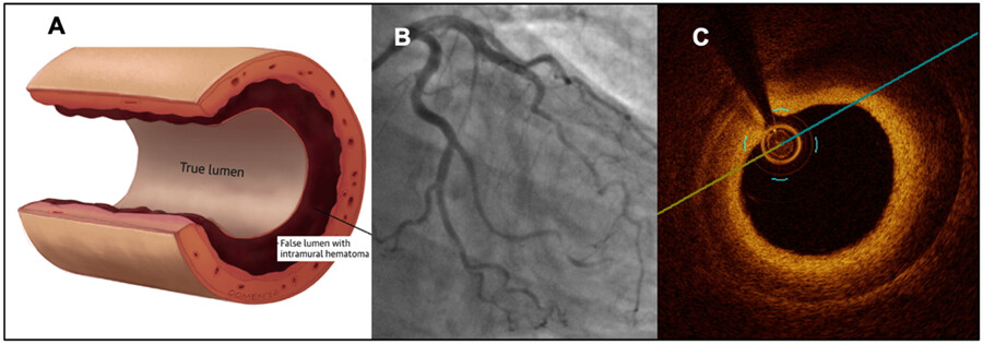 Spontaneous coronary artery dissection (SCAD): A contemporary review