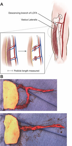 Increasing Pedicle Reach with Musculocutaneous Perforator Dissection in Anterolateral Thigh Free Flaps