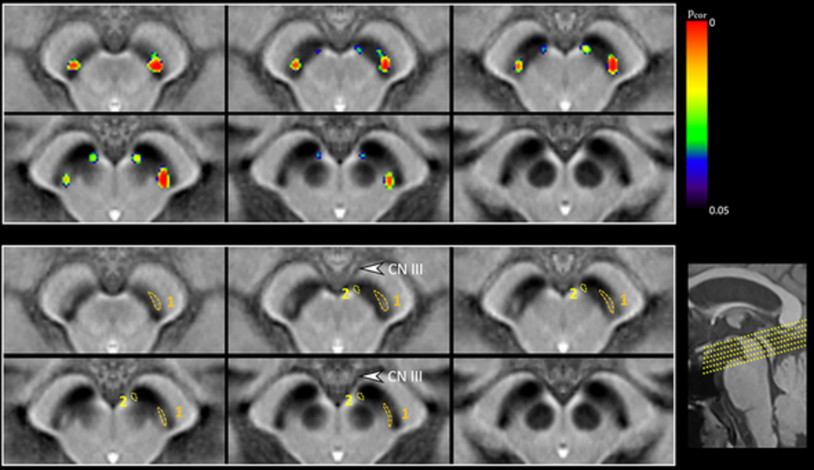 Early-stage Parkinson's disease: Abnormal nigrosome 1 and 2 revealed by a voxelwise analysis of neuromelanin-sensitive MRI