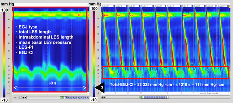 Prolonged measurement improves the assessment of the barrier function of the esophago-gastric junction by high-resolution manometry