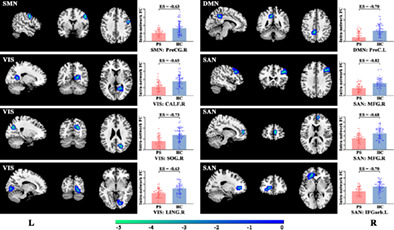 Abnormal functional connectivities patterns of multidomain cognitive impairments in pontine stroke patients