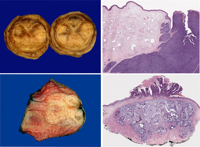 Metastatic solid tumours to the penis: a clinicopathologic evaluation of 109 cases from an international collaboration