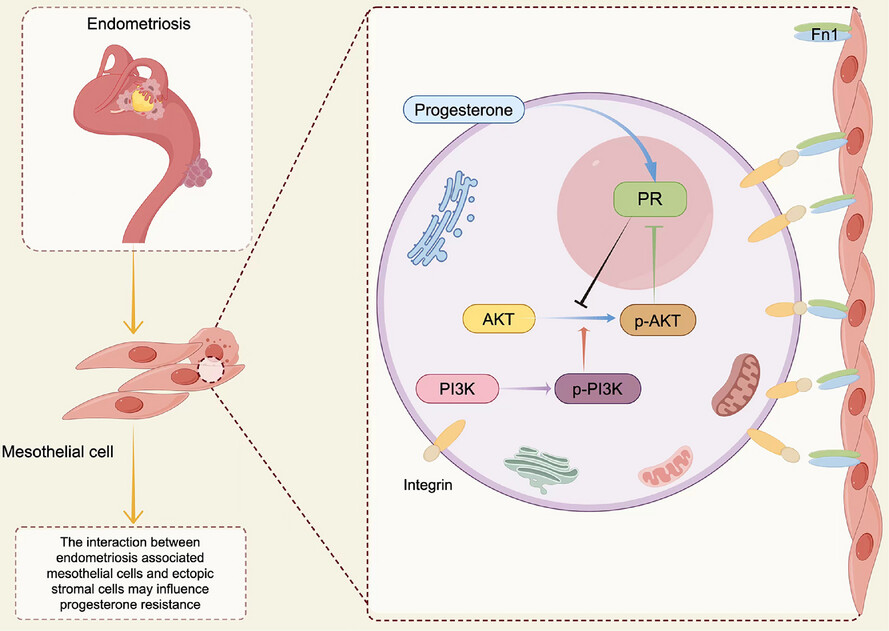 Single-cell transcriptomic atlas of different endometriosis indicating that an interaction between endometriosis-associated mesothelial cells (EAMCs) and ectopic stromal cells may influence progesterone resistance