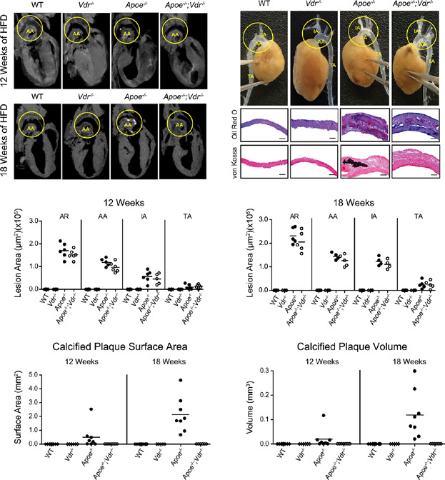 Absence of the Vitamin D Receptor Inhibits Atherosclerotic Plaque Calcification in Female Hypercholesterolemic Mice