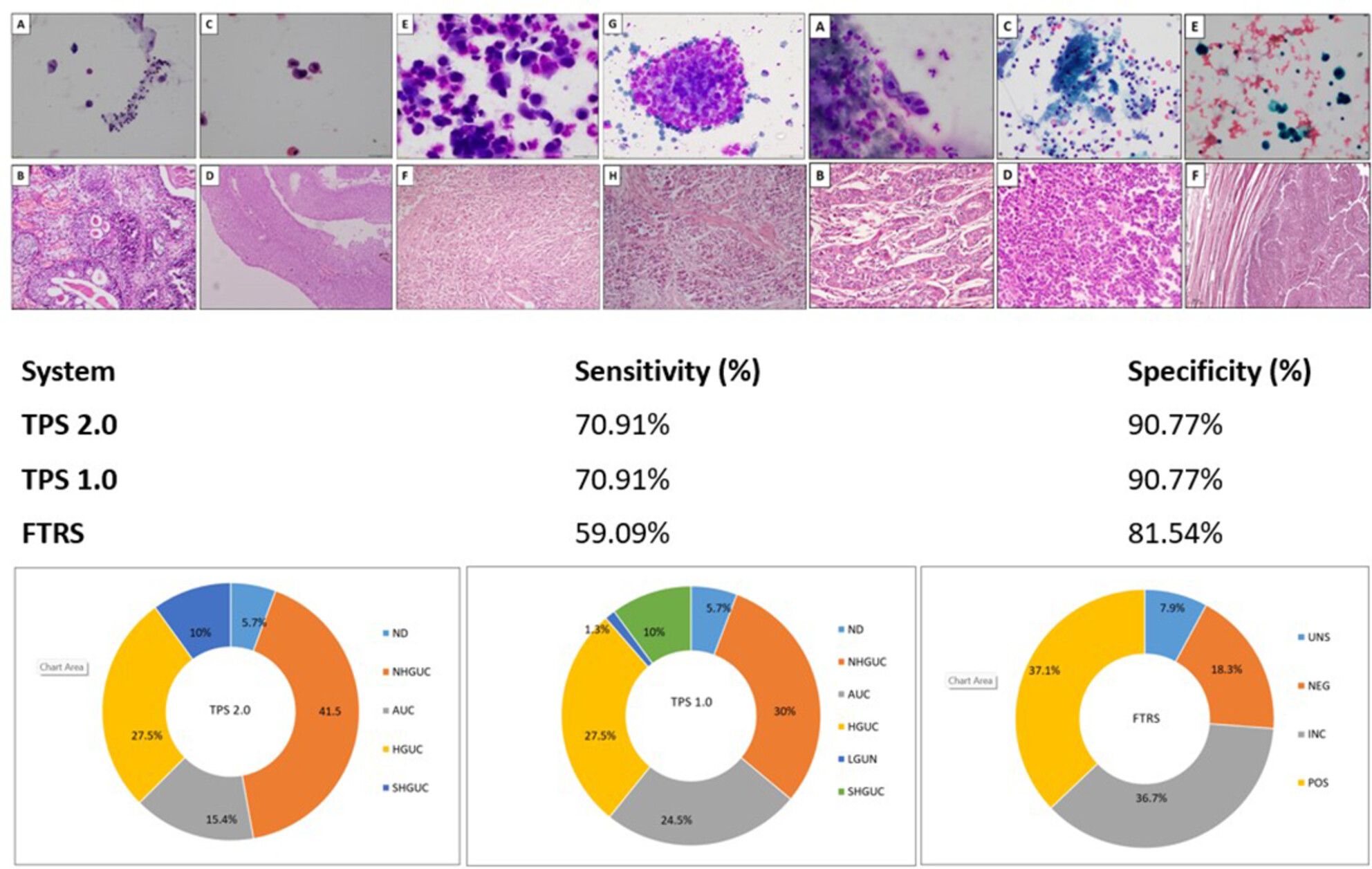 Evaluation of Diagnostic Accuracy of the Paris System (TPS 2.0) in Urine Cytology Specimens: An Institutional Experience From a Large Cohort of a Tertiary Care Centre