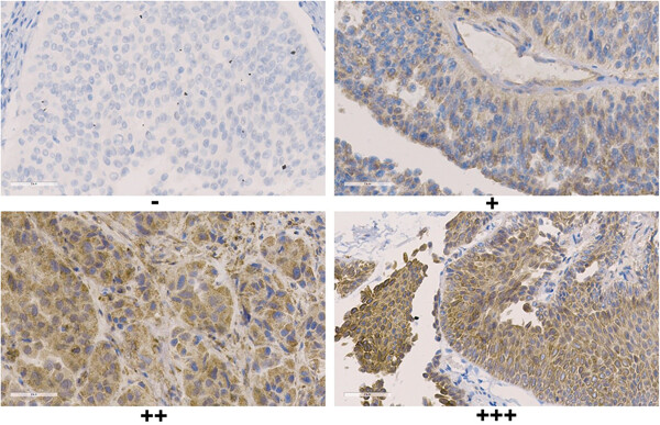 ARPC4 promotes bladder cancer cell invasion and is associated with lymph node metastasis