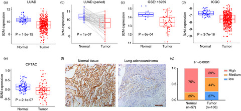 B2M gene expression shapes the immune landscape of lung adenocarcinoma and determines the response to immunotherapy