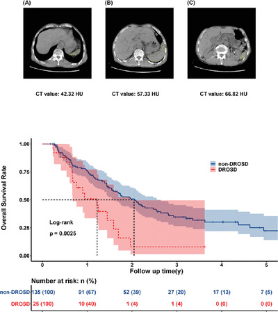 Prognostic value of diffuse reduction of spleen density on postoperative survival of pancreatic ductal adenocarcinoma: A retrospective study