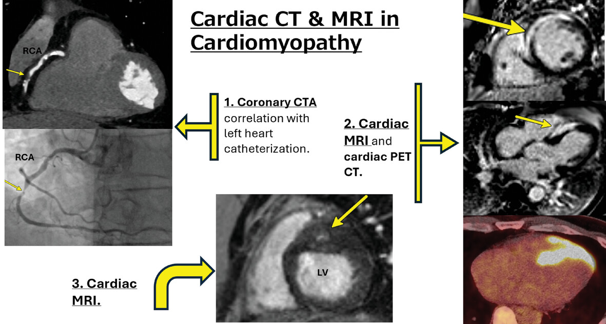 Advanced Computed Tomography and Magnetic Resonance Imaging in Ischemic and Nonischemic Cardiomyopathies