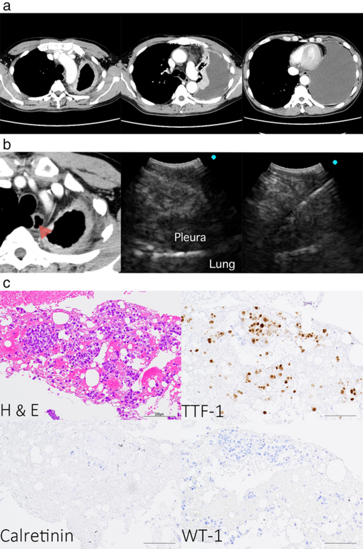 Pseudomesotheliomatous carcinoma of lung adenocarcinoma diagnosed using transesophageal ultrasound-guided bronchoscopic aspiration