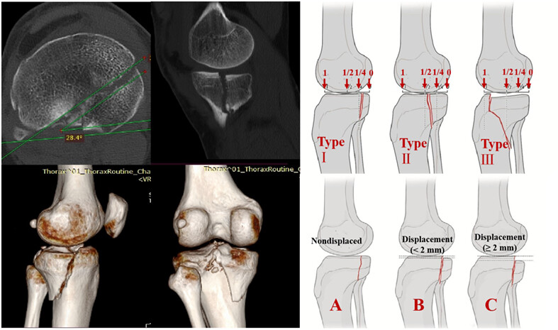 Introduction and An Analysis of Inter- and Intra-observer Validity to the Classification of Hoffa-Like Tibial Plateau Fractures