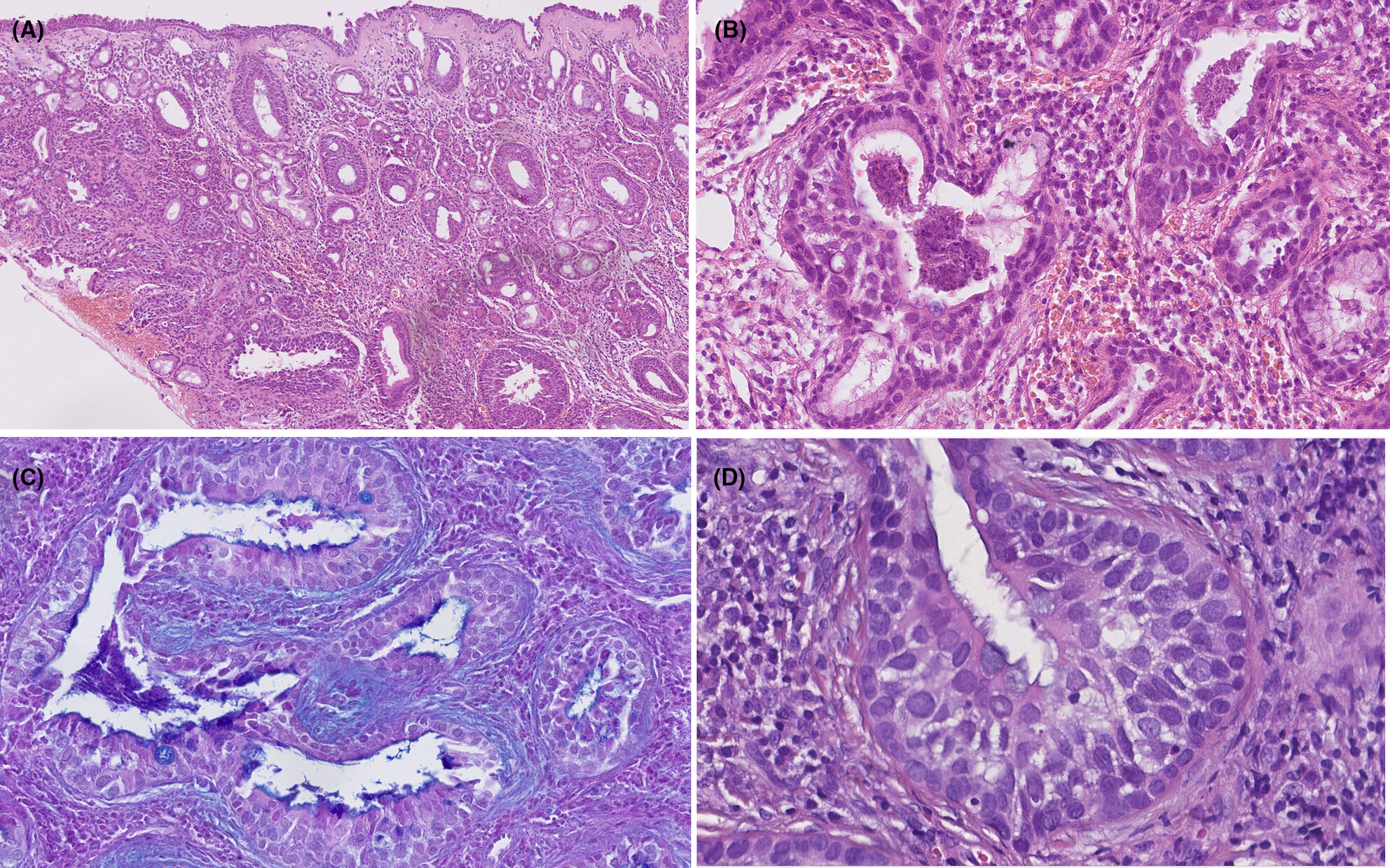 Sinonasal adenosquamous carcinomas arising in seromucinous hamartoma or respiratory epithelial adenomatoid hamartoma with atypical features: Report of five detailed clinicopathological and molecular characterisation of rare entity
