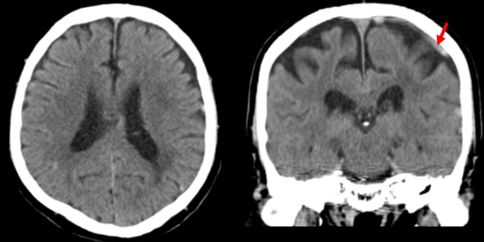 Rapidly progressive dementia due to superior sagittal sinus dural arteriovenous fistula: A case report