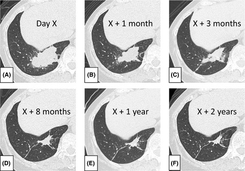 Spontaneously shrinking lung mass due to Mycobacterium avium mimicking lung cancer