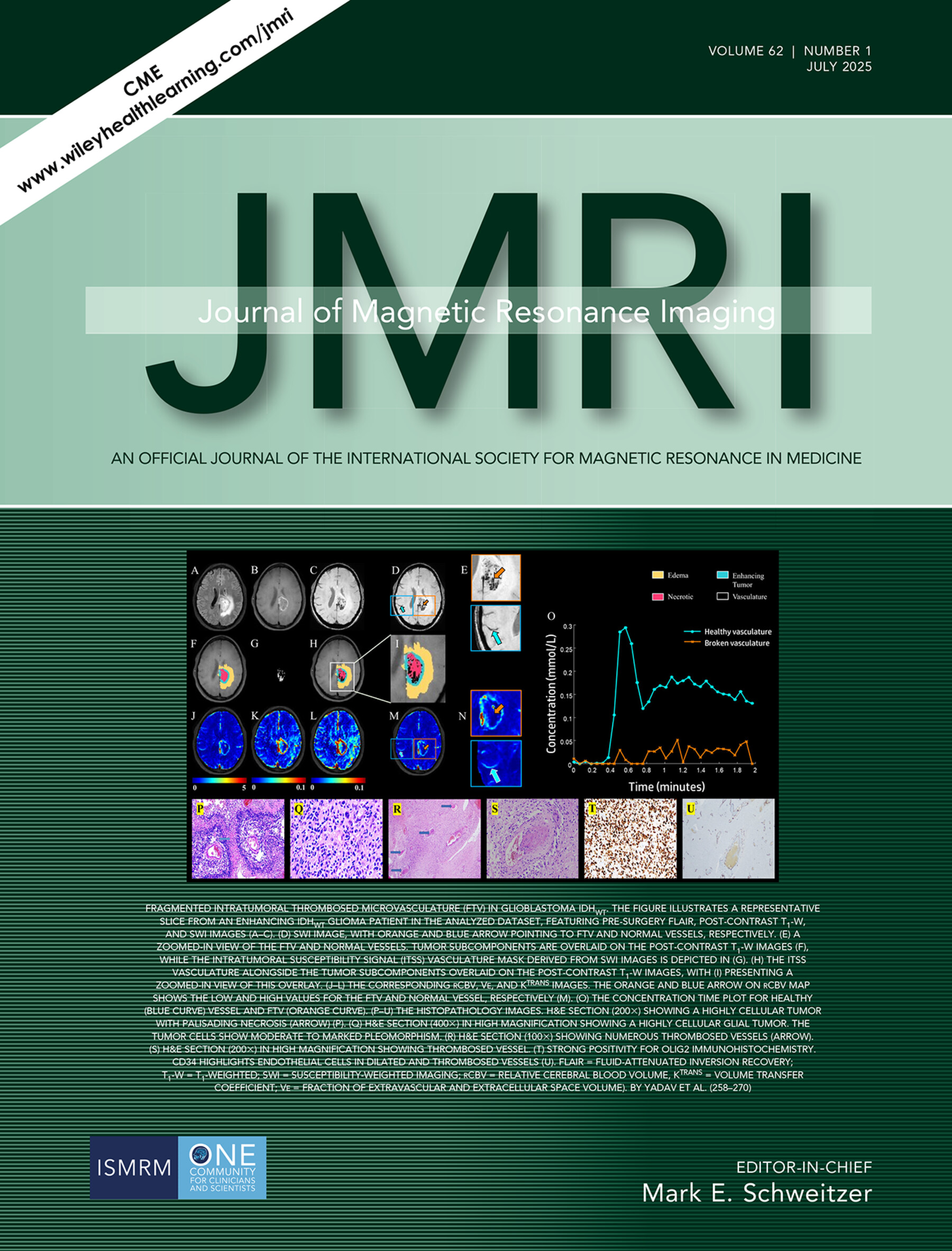 Presence of Fragmented Intratumoral Thrombosed Microvasculature in the Necrotic and Peri-Necrotic Regions on SWI Differentiates IDH Wild-Type Glioblastoma From IDH Mutant Grade 4 Astrocytoma