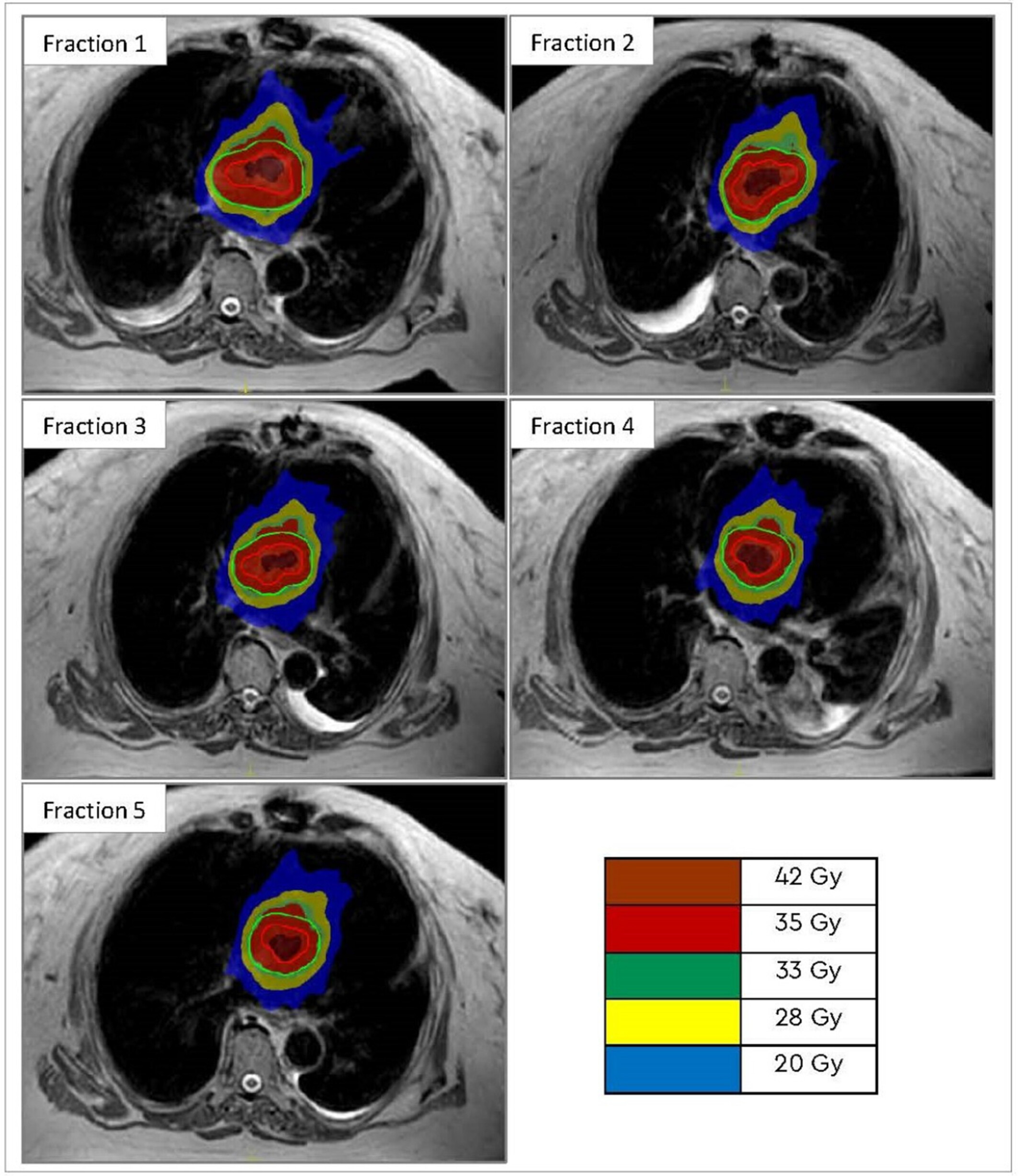 MR-Linac guided adaptive stereotactic ablative body radiotherapy for recurrent cardiac sarcoma with mitral valve bioprosthesis – a case report