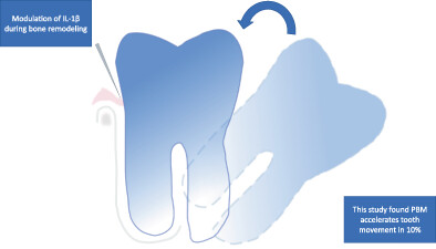 Photobiomodulation increases uprighting tooth movement and modulates IL-1β expression during orthodontically bone remodeling