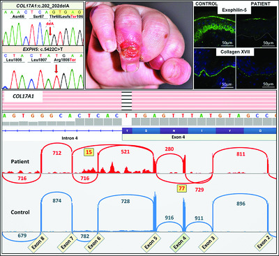 Next generation sequencing identifies double homozygous mutations in two distinct genes (EXPH5 and COL17A1) in a patient with concomitant simplex and junctional epidermolysis bullosa