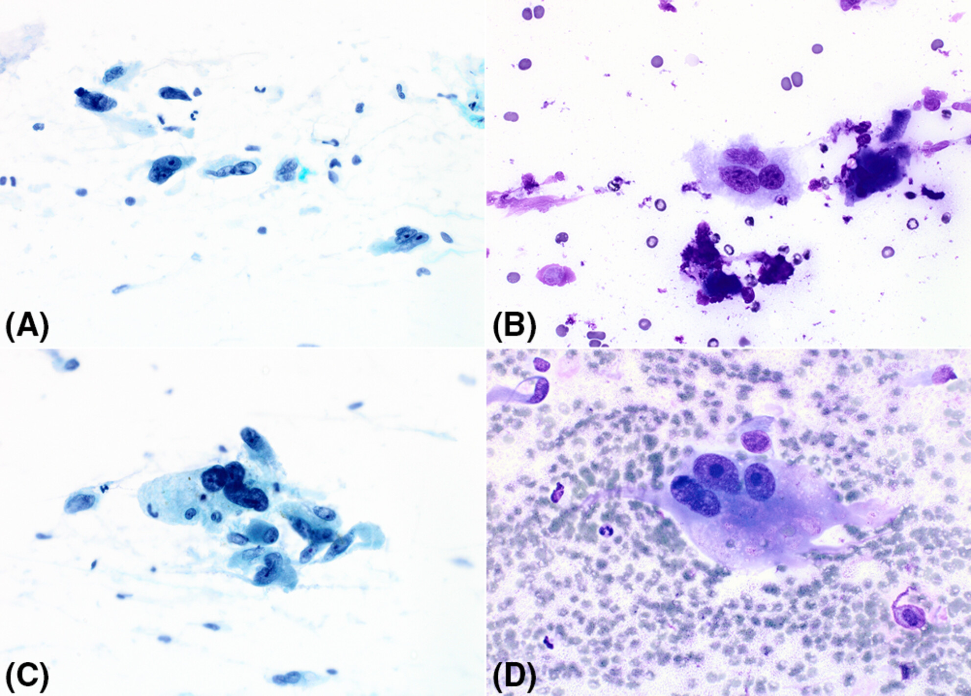 Fine needle aspiration cytopathology of pleomorphic dermal sarcoma