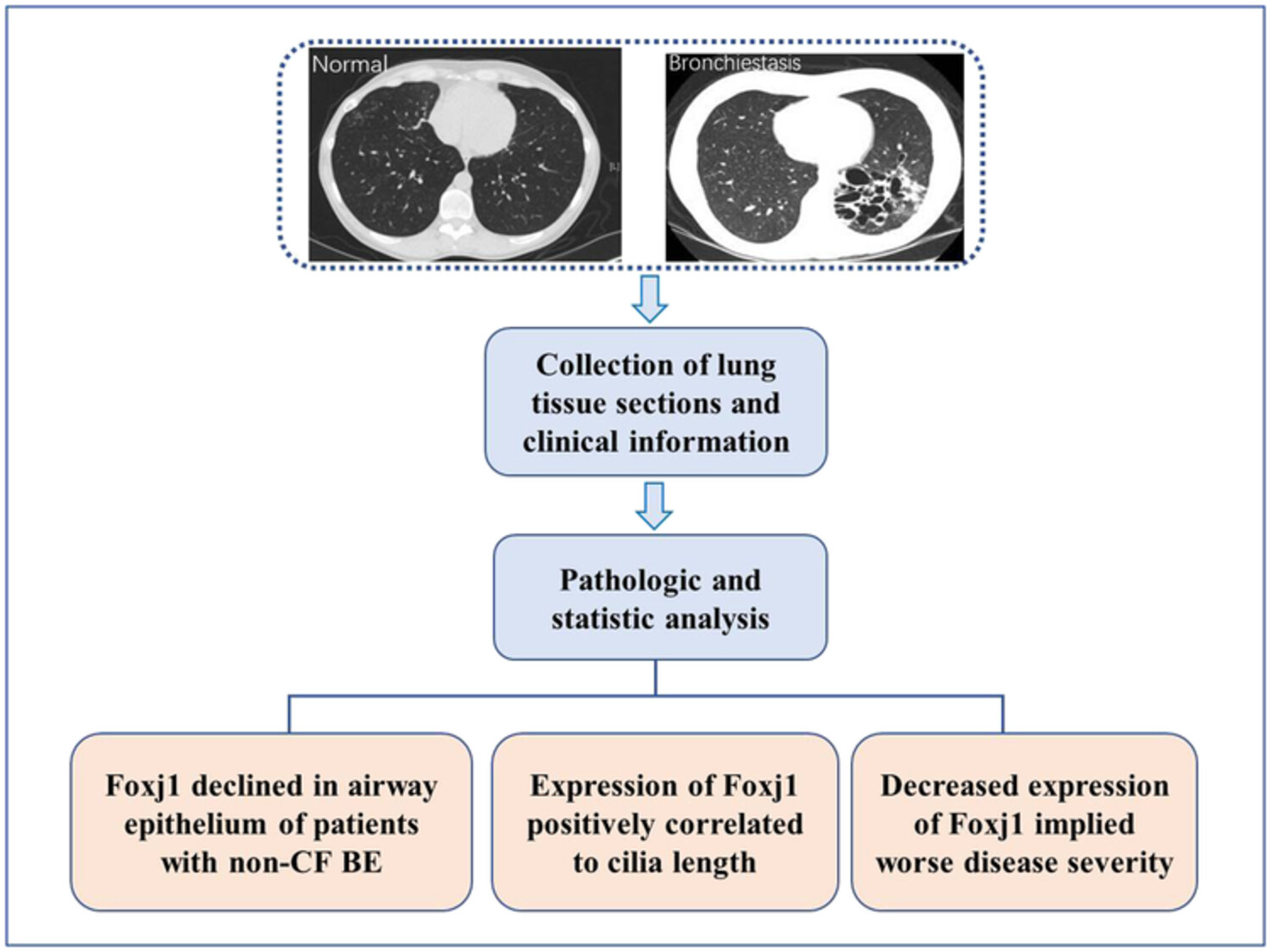 Down-expression of Foxj1 on airway epithelium with impaired cilia architecture in non-cystic fibrosis bronchiectasis implies disease severity